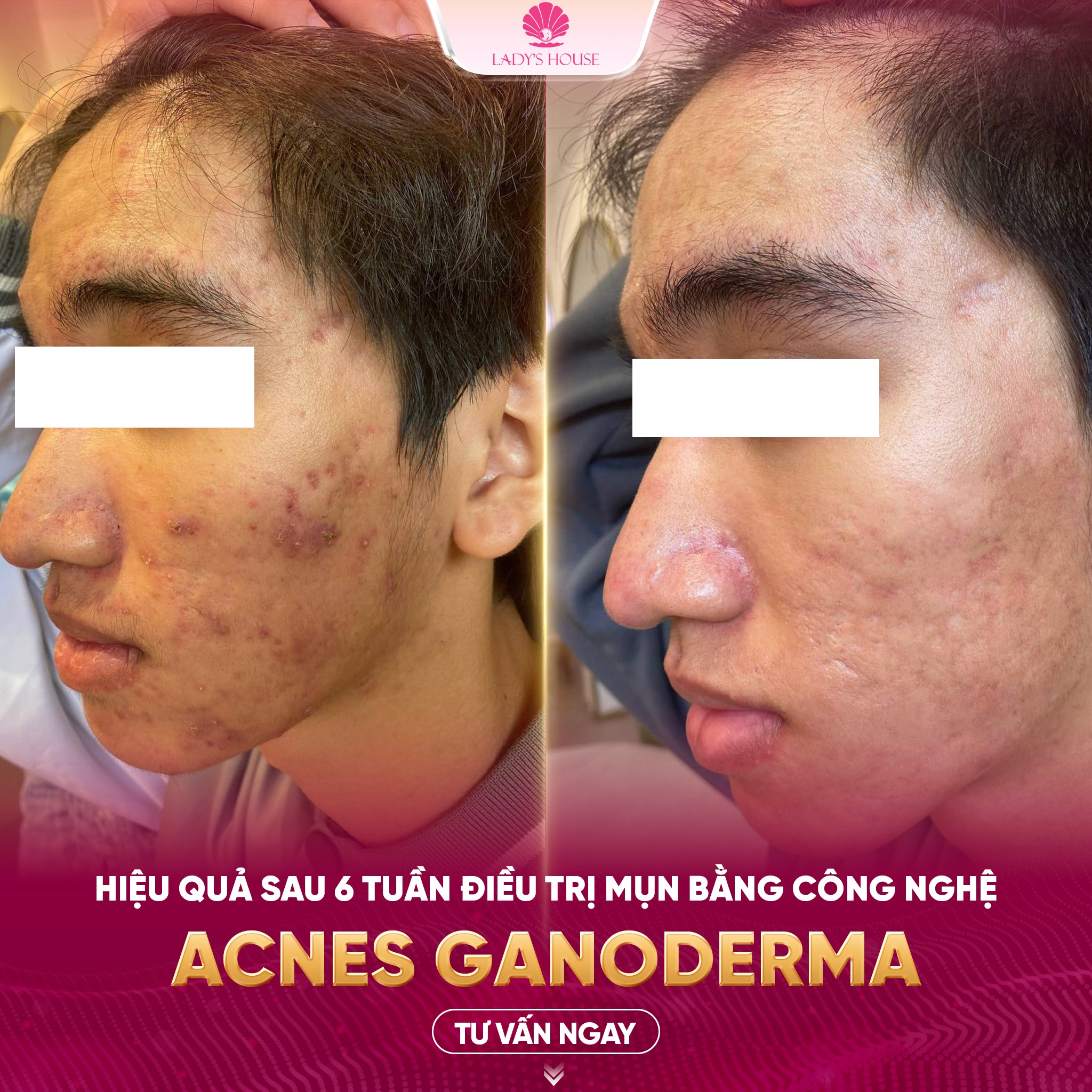 acnes ganoderma lady's house