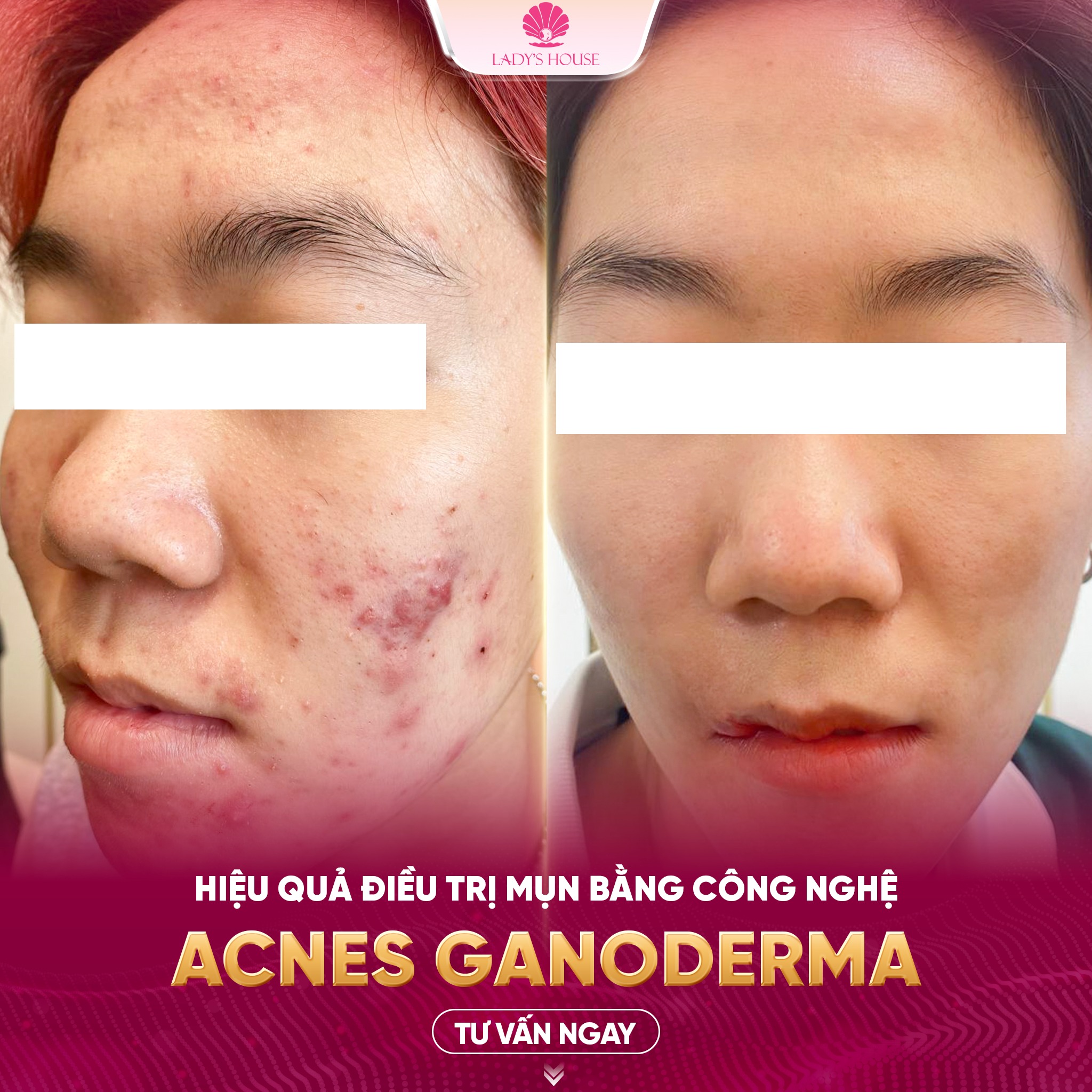 Acnes Ganoderma: Giải pháp trị mụn hiệu quả, mờ thâm tại Lady's House Spa & Clinic