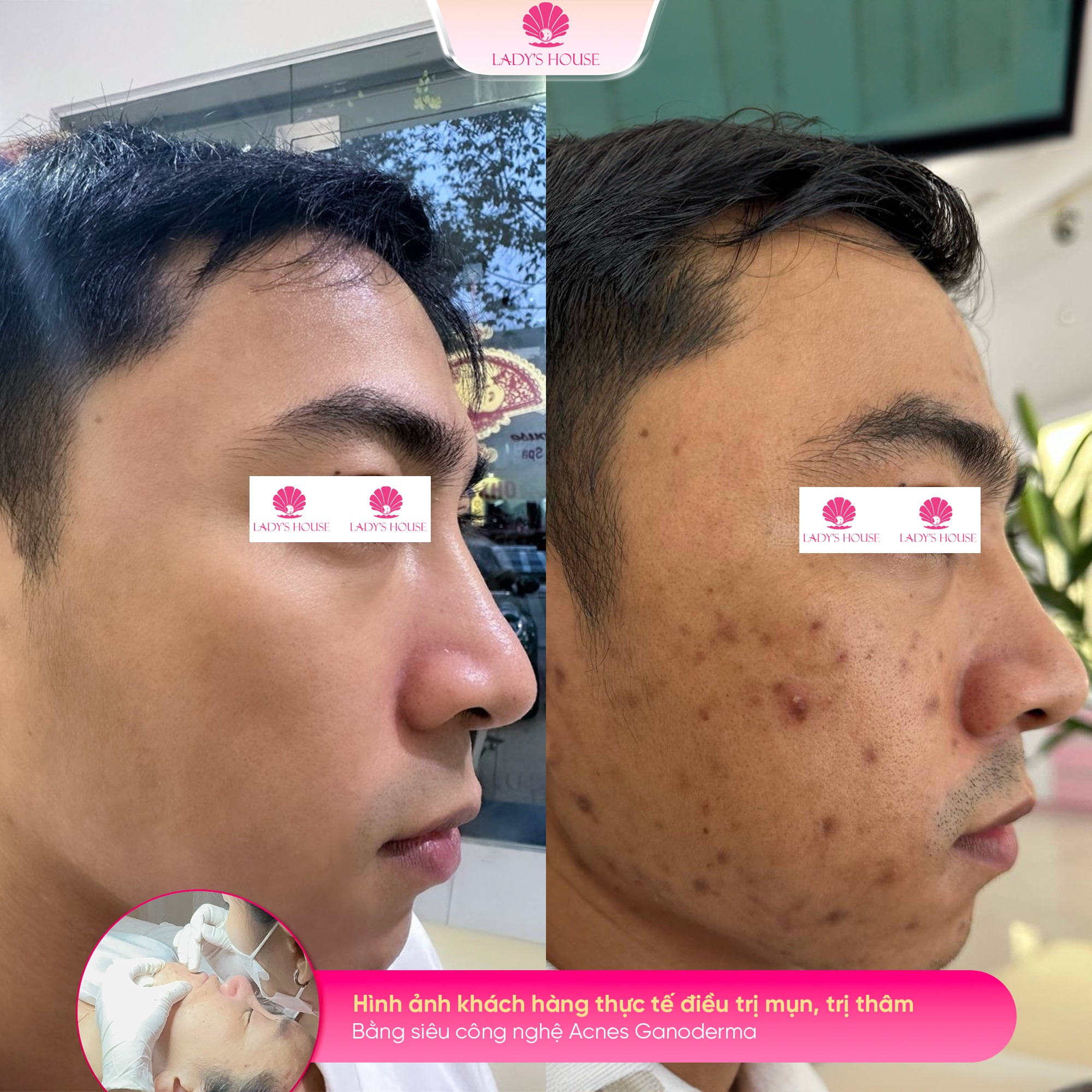 điều trị mụn acnes ganoderma