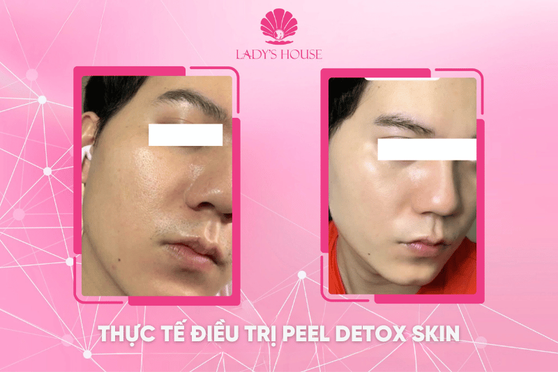 Peel detox skin Lady's House