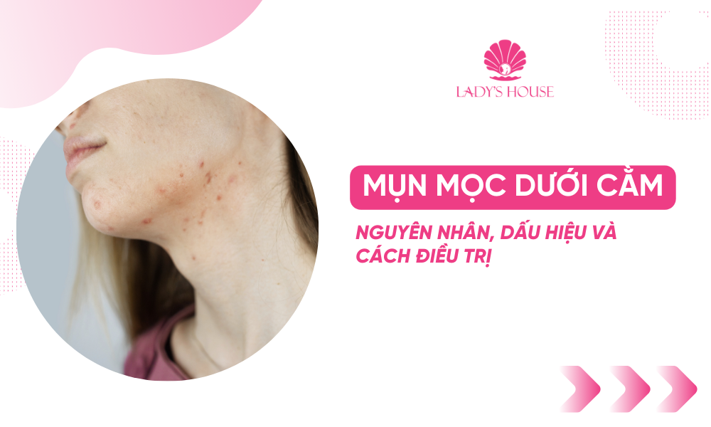 Mụn Mọc Dưới Cằm: Nguyên Nhân, Dấu Hiệu và Cách Điều Trị