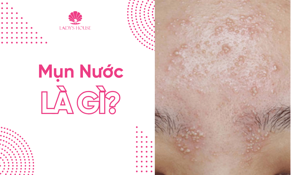 Mụn nước là gì?