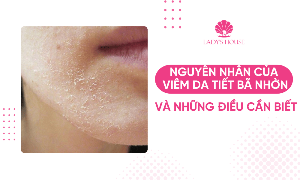 Nguyên nhân của viêm da tiết bã nhờn và những điều cần biết