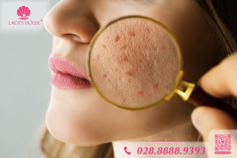 cách trị mụn ẩn hiệu quả tại nhà