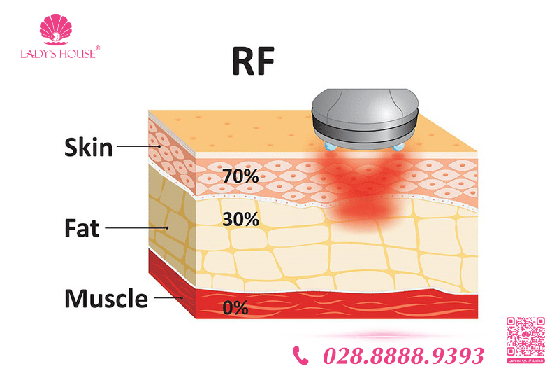 công nghệ sóng RF tác động sâu vào da
