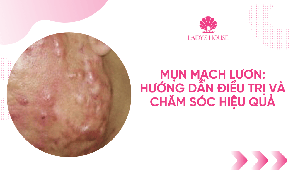 Mụn Mạch Lươn: Hướng Dẫn Điều Trị và Chăm Sóc Hiệu Quả