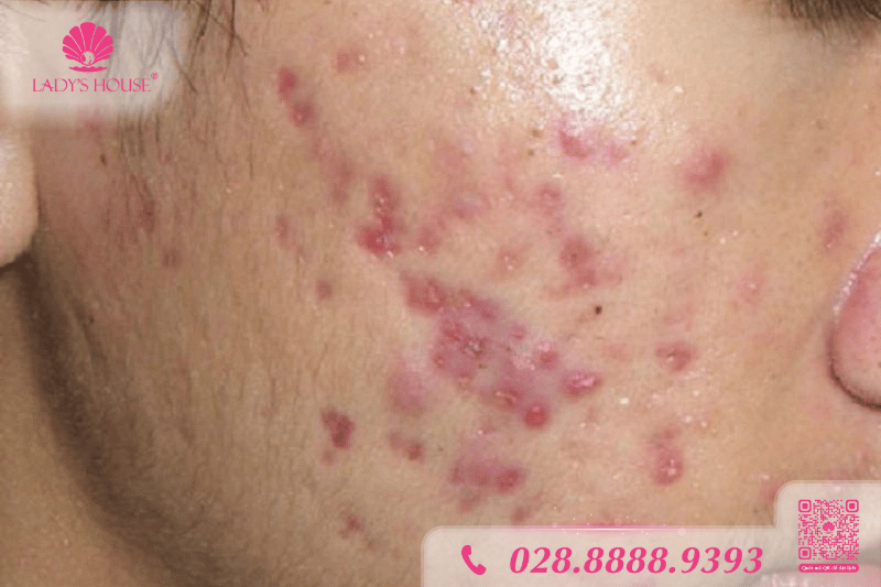đỏ da sau mụn ở lứa tuổi thanh thiếu niên