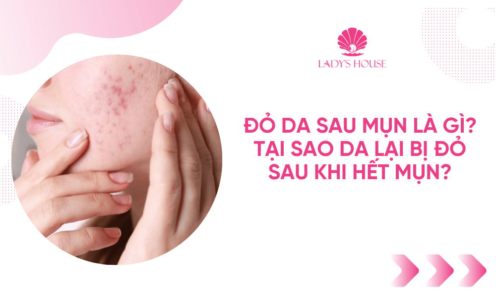 Đỏ Da Sau Mụn Là Gì? Tại Sao Da Lại Bị Đỏ Sau Khi Hết Mụn?