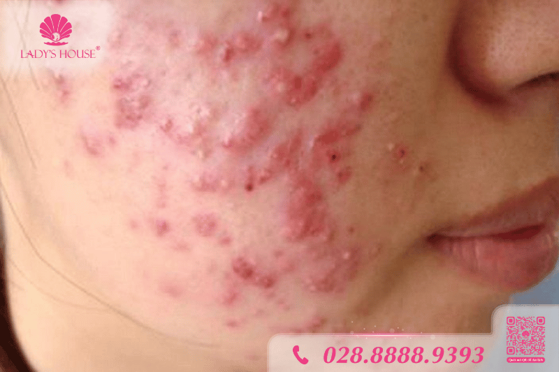 mụn mạch lươn ở tuổi dậy thì