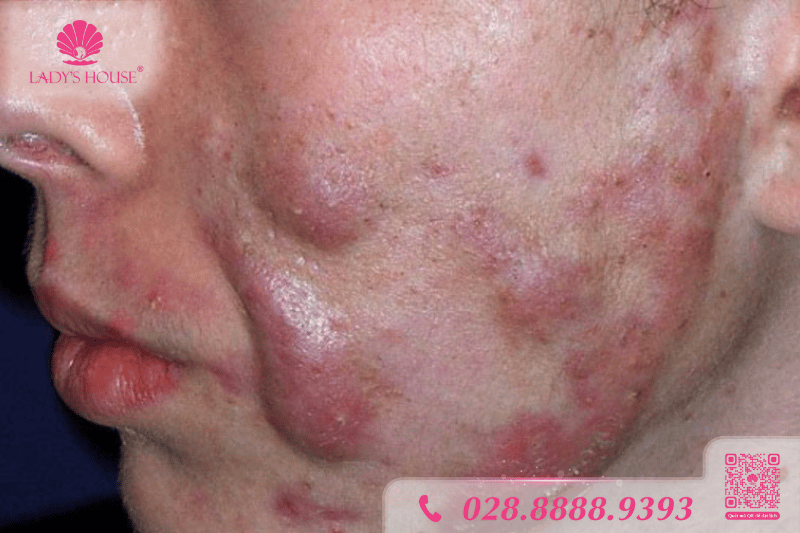 mụn mạch lươn tình trạng nặng