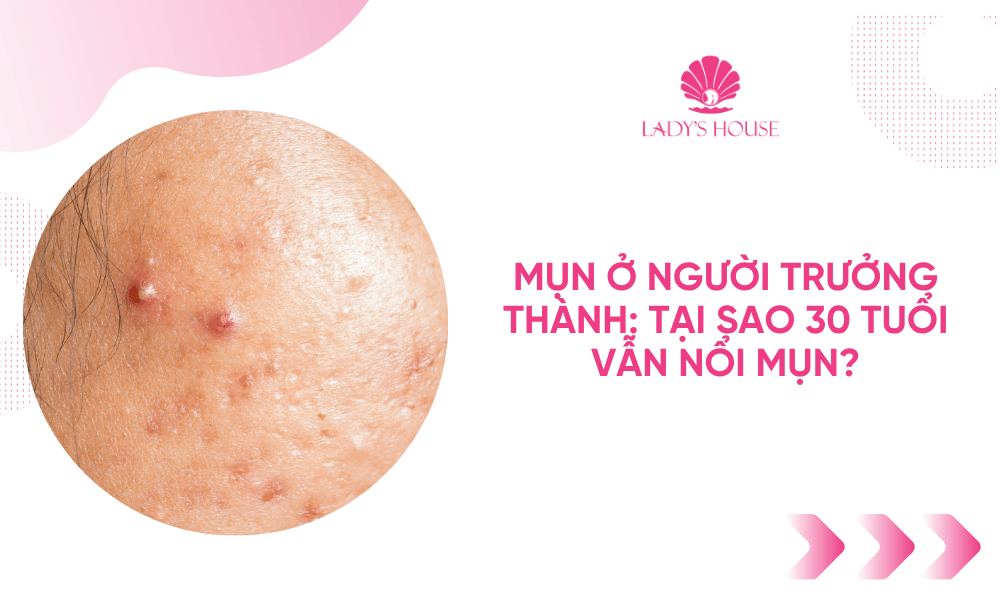 Mụn ở người trưởng thành: Tại sao 30 tuổi vẫn nổi mụn?